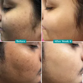 pilgrim-10-vitamin-c-serum-30ml-for-glowing-skinwith-5-niacinamide-hyaluronic-glycolic-acidfades-dark-spots-pigmentationfor-all-oily-combination-normal-skin-beginner-friendly-men-women-00021-d